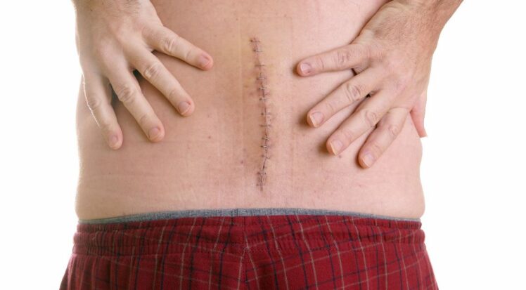 فیزیوتراپی بعداز جراحی دیسک کمر