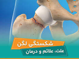شکستگی لگن چیست؟چه علائمی دارد؟فیزیوتراپی بعد از جراحی لگن چگونه است؟