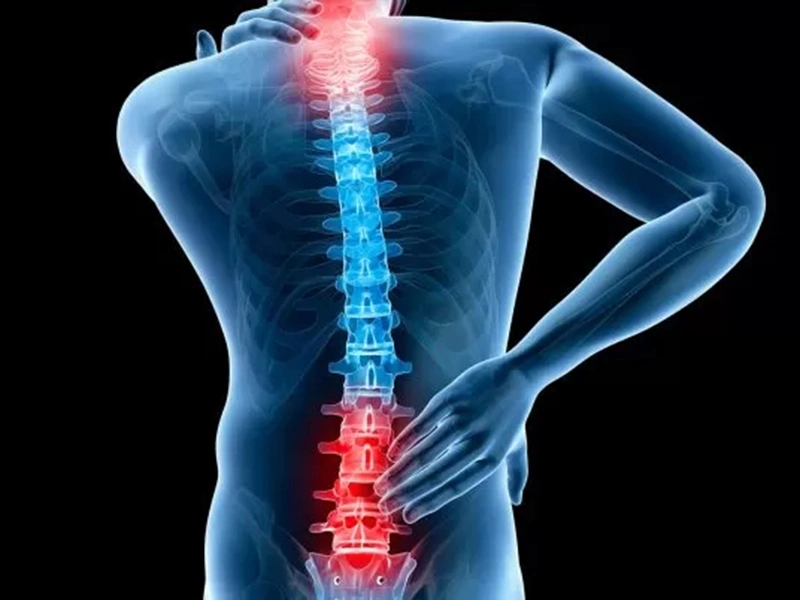 علائم بیرون زدگی دیسک کمر